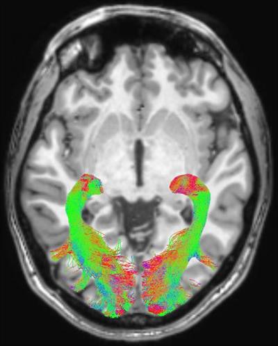 Left and right optic radiation image is overlaid onto a T1-weighted axial volume image. Optic radiation images were obtained based on diffusion-weighted volume images through constrained spherical deconvolution fitting and related tractography. Each bundle was automatically colored according to tract main directionality: red for left to right, green for anterior to posterior, and blue for inferior to superior. Image courtesy of the RSNA.