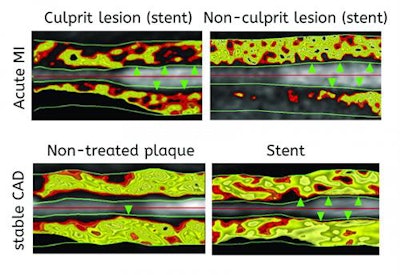 A new imaging methodology called FAI identifies inflamed artery lesions that pose the most risk to patients. Image courtesy of Antonopoulos et al and Science Translational Medicine.
