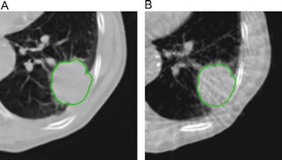 Example of planning CT and CBCT images. A: Treatment planning CT scan. B: kV cone-beam CT scan of the same patient prior to the first treatment fraction. The gross tumor volume is indicated in green. © 2017 van Timmeren JE, Leijenaar RTH, van Elmpt W, et al. (Radiother Oncol, June 2017, Vol. 123:3, pp. 363-369).