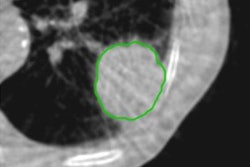2017 07 14 11 27 26 66 2017 07 17 Radiomics Cbct 20170714183300