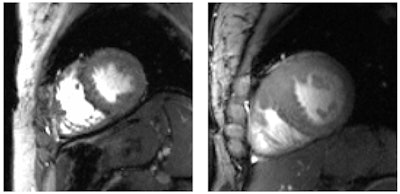 High-resolution short-axis views of the heart acquired at 7 tesla of a healthy subject (left) and a patient with hypertrophic cardiomyopathy (right).