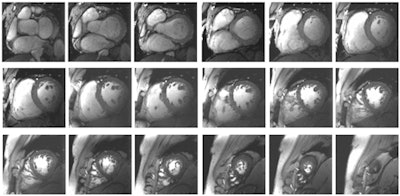 The high-resolution (1 x 1 x 2.5-mm) dataset of the heart was acquired at 7 tesla from a healthy subject. The images show whole heart coverage from the apex to the base of the heart. All images are courtesy of Thoralf Niendorf, PhD.