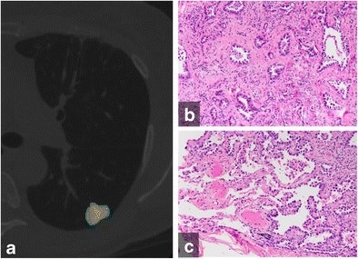 (A) Color-coded CANARY output overlay of invasive adenocarcinoma (yellow-pink-cyan). Cyan represents low-risk components, while pink and yellow indicate intermediate-risk components. The software found the nodule included 32% low-risk components, 66.9% intermediate-risk components, and 1% high-risk components. (B) Histologic image from the central area of the tumor shows the invasive acinar growth pattern (C) Histologic image from the tumor periphery showing noninvasive lepidic growth pattern and adjacent uninvolved lung parenchyma (H&E stain, 200x original magnification). Images courtesy of European Radiology.
