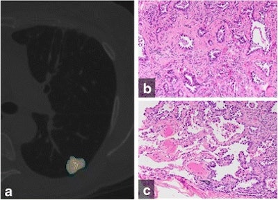 (A) Color-coded CANARY output overlay of invasive adenocarcinoma (yellow-pink-cyan). Cyan represents low-risk components, while pink and yellow indicate intermediate-risk components. The software found the nodule included 32% low-risk components, 66.9% intermediate-risk components, and 1% high-risk components. (B) Histologic image from the central area of the tumor shows the invasive acinar growth pattern (C) Histologic image from the tumor periphery showing noninvasive lepidic growth pattern and adjacent uninvolved lung parenchyma (H&E stain, 200x original magnification). Images courtesy of European Radiology.
