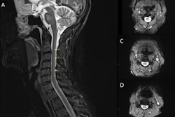 2017 08 07 09 56 25 264 2017 08 07 Mri Myelopathy 20170807165721