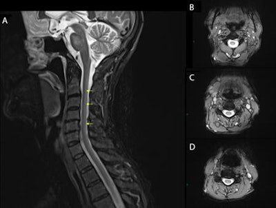 Sagittal T2-weighted MRI sequence of the cervicothoracic spinal cord (A). Yellow arrows indicate subtle high T2 signal within the dorsal column of the cervical spinal cord extending from C2 down to C7 level. Axial T2-weighted image of the cervical spinal cord at the level of respective yellow arrows, descending (B, C, and D). Images courtesy of BMJ Case Reports.