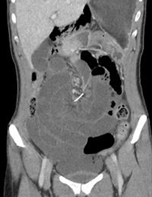 Wire Ct Radiopaque CT finds dental brace wire in bowel | AuntMinnieEurope