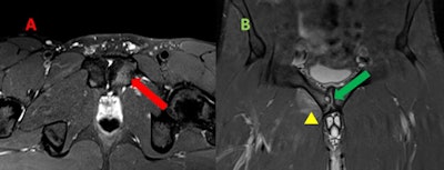 Mild osteitis pubis in a man. A: Transversal T2-weighted fat-suppressed MR image reveals parasymphyseal hyperintensity extending from the subchondral plate of left pubic body, which reflects edema due to increased stress response and areas of trabecular microtrauma. B: Coronal T2-weighted fat-suppressed MR image shows articular surface irregularity, erosions, osteophytes, and subchondral cyst (green arrow). In addition, there is an edema of myotendinous attachments of adductor seen as a coexistent tendinopathy and grade 1 strain (yellow arrowhead).