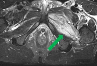 Coronal T2-weighted fat-suppressed MR image shows a partial tear of pectineus muscle in a 27-year-old football player who presented with hyperintense hemorrhage and tearing up to 50% of muscle fibers (green arrow); focal defect shows partial retraction of muscle fibers. Grade 2 strain (moderate partial muscle tear) was positive for significant fiber disruption, probably including some retraction, fascial injury, and intermuscular hematoma. All images courtesy of Dr. Valentin Sinitsyn; Dr. Maria Lisitskaya, PhD; and Dr. Sergey Khaykin, PhD, presented at the 2017 annual meeting of the ESSR.