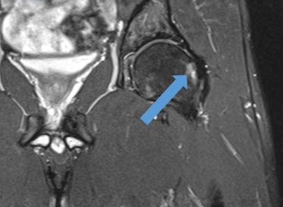 Coronal T2-weighted fat-suppressed MR image of the hip shows cam-type femoroacetabular impingement in a player. Note the increased signal intensity of subchondral femur head due to edema and cystic changes (blue arrow).