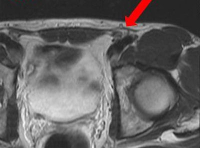Inguinal hernias, whether occult or obvious, and lipomas of the spermatic cord or round ligament are important etiologies to consider in the diagnosis of groin pain. This axial T2-weighted MR image of the pelvis shows a spermatic cord lipoma.