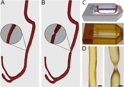 3D-printed microfluidic blood vessel chip, with and without stenotic defect. (A) Healthy and (B) diseased 3D-printed blood vessels; (C) image of the 3D model (top) and picture of the final 3D model with support structures removed (bottom); and (D) close up of healthy and diseased blood-vessel channels. Image reproduced from Lab on a Chip CC BY 3.0.