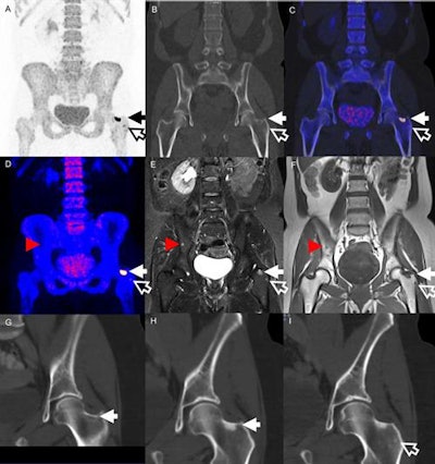 Images are from a 51-year-old woman treated for locally advanced breast cancer. Two lesions in the left hip were identified on both PET (A-C) and MRI (D-F) (solid and hollow arrows). The larger lesion could be found retrospectively on a diagnostic CT (G) one month prior to PET. CT two months after treatment (H) shows a sclerotic transformation of the lesion. The smaller lesion (I) has also turned sclerotic. MRI showed an additional lesion in the pelvic bone (red arrowheads) not identified on PET. Images courtesy of JNM.