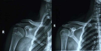 Anteroposterior and oblique view of x-ray in a 15-year-old wrestler (weight 94 kg, height 189 cm, duration of training three years) shows a fracture of the surgical neck of humerus (Salter-Harris type I). Injury occurred during training (hard wrestling) in a defensive position when the opponent fell on his shoulder (thunder action). The patient was absolutely normal after six weeks of conservative treatment.