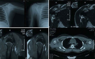Tenosynovitis with calcific tendinitis of biceps muscle. Anteroposterior (AP) view of x-ray (top left), coronal fat-suppressed proton density-weighted fast spin-echo MR images (top right and bottom left), and axial CT scan (bottom right) of right shoulder in a 17-year-old wrestler (weight 75 kg, height 165 cm, duration of training three years) shows calcification in the biceps tendon on CT, along with tenosynovitis in this region. The wrestler sustained the injury in competition when in the attack position and was treated conservatively. He returned to practice after 15 days, but he continued to have pain from time to time throughout the study period. All images courtesy of Dr. Shalini Agarwal.