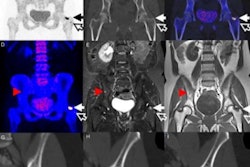2017 08 24 11 10 17 376 2017 08 25 Jnm Bone Mets Thumb 400
