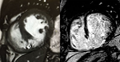 Cine and MR image of a 67-year-old male patient after acute myocardial infarction
