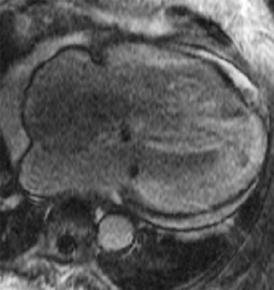 Cardiac late-enhancement MR image in an 80-year-old female