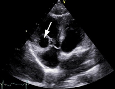Transthoracic echocardiography in a 42-year-old female with atypical chest pain