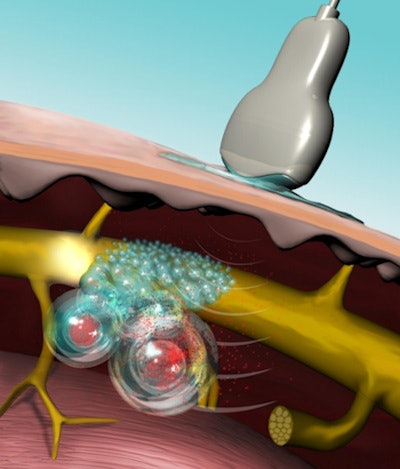 Ultrasound interacts with the protoporphyrin IX contained in the bilayer to burst the liposome open and release the anesthetic TTX. Image courtesy of Mary O'Reilly.