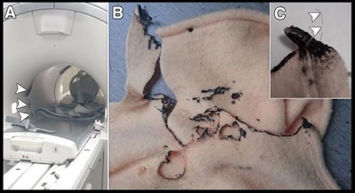Sequence of images shows the following: (A) Smoke damage inside PET/MRI scanner, (B) combustion of blanket, and (C) small copper filaments believed to have caused the incident. Image courtesy of Radiology.
