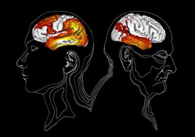 PET images show the differences in tau pathology and regions of AV-1451 uptake for early-onset Alzheimer's (left) and late-onset Alzheimer's (right). Patients with early-onset Alzheimer's (before age 65) show significantly higher uptake in lateral, temporal, parietal, frontal, and occipital lobe regions, compared with late-onset Alzheimer's (after age 65), which demonstrated the possibility to distinguish between the two conditions based on age using AV-1451-PET. Images courtesy of Drs. Annie Hallén/Michael Schöll.