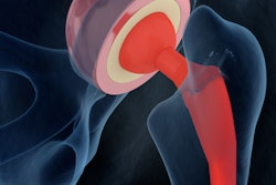 2017 09 08 19 30 7985 Hip Joint 3 D 400