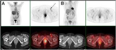 FDG-PET/CT before treatment (A) shows an anal tumor on axial slices and a left inguinal node (black arrow). FDG-PET/CT four months after chemoradiotherapy (B) shows persistent increased FDG uptake in anal canal (noncomplete metabolic response) but complete regression of inguinal node uptake. Persistent disease was proved by biopsy. Images courtesy of JNM.