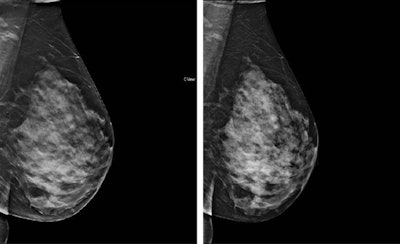 Synthetic (left) and FFDM (right) mediolateral oblique images of a 51-year-old woman. All images courtesy of Dr. Julia Garayoa.