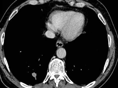 Small right basal lung cancer was missed on this CT scan