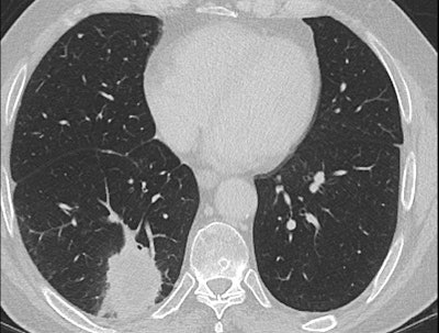 Subsequent CT scan several months later showed a much bigger lesion
