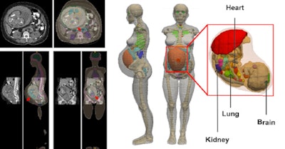 Representative slices showing transverse (top), sagittal (bottom and left), and coronal (bottom and right) views of the developed computational phantoms at 35 weeks gestational age. Images also show registration between abdominal CT images of the patient and the computational phantom for the development of patient-specific pregnant computational models. A zoomed view of the 3D patient-specific pregnant computational model with the embedded fetus also is shown. All images courtesy of Habib Zaidi, PhD.