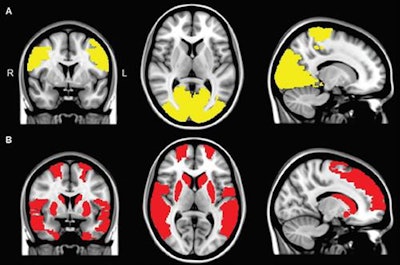 Functional MR images show reduced regional connectivity in Parkinson's patients (A) and in Parkinson's patients with visual hallucinations (B). A regional functional connectivity analysis revealed lower connectivity in patients with visual hallucinations and in patients without hallucinations, compared with control subjects, in the paracentral and occipital regions (yellow areas in A). Functional connectivity in the frontal, temporal, and subcortical regions was exclusively lower in Parkinson's patients with visual hallucinations, compared with controls (red areas in B). Images courtesy of Radiology.