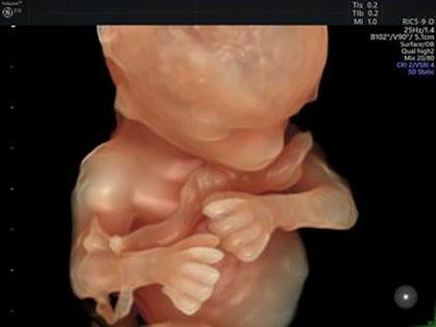 The Voluson E10 system offers real-time 4D to visualize anatomical structures and functionality. Image courtesy of GE Healthcare.