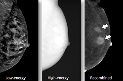 Typical example of a CESM exam, which consists of a low-energy image (comparable with full-field digital mammography), followed by the acquisition of a high-energy image (not for diagnostic purpose but used for postprocessing), and the recombined images (showing white areas of contrast captation). In this example, the multifocal invasive breast cancer (arrows) can be appreciated much easier than on the low-energy (mammographic) image of this dense breast. All images courtesy of Dr. Marc Lobbes, PhD.
