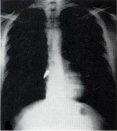 X-ray of a bullet in the heart. Image from Wikimedia Commons.