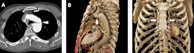 A 59-year-old man who was experiencing exercise intolerance and was found to have widely disparate upper and lower extremity blood pressures. A: Axial postcontrast 2D CT image demonstrates marked narrowing/coarctation of the aorta (white arrowhead) just distal to the takeoff of the left subclavian artery. B: Cinematic rendering image displays the coarctation in 3D (white arrowhead) with realistic shadowing effects and a detailed depiction of the relative positions of other vascular structures such as the immediately inferior left main pulmonary artery. C: Another cinematic-rendered visualization demonstrates representative collateral vessels (bilateral internal mammary arteries, white arrows).