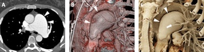 A 52-year-old woman with a history of pulmonary artery aneurysm of unknown etiology. A: Axial postcontrast 2D CT image demonstrates marked enlargement of the main pulmonary artery (measuring 5.2 cm, white arrowheads). B: Volume-rendered image also demonstrates the dilated main pulmonary artery (white arrowheads), with improved visualization of the relationship of the aneurysmal vessel relative to other vascular structures such as the aortic arch and the branching pulmonary vessels. C: Cinematic-rendered visualization once more shows the aneurysmal main pulmonary artery (white arrowheads) and its 3D relationship to other major vessels. The photorealistic detail and shadowing available with cinematic rendering creates high contrast that better highlights the smaller pulmonary vessels that overlie the main pulmonary artery in this view (white arrow).