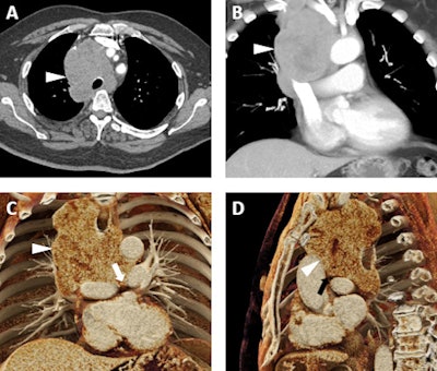 A 66-year-old man with a known diagnosis of pulmonary large cell neuroendocrine tumor. A: Axial postcontrast 2D CT image demonstrates a confluent lymph node mass (white arrowhead) occupying much of the superior mediastinum with encasement of the trachea and interdigitation among multiple vascular structures. B: Volume-rendered image also demonstrates the mass (white arrowhead), which abuts and/or narrows the superior vena cava, the innominate veins, the aorta, and major arterial branches arising from the aortic arch, and the main, left, and right pulmonary arteries. C and D: Cinematic-rendered visualizations; the photorealism of these renders allows for the depiction of the tumor infiltrating between the left and right pulmonary arteries (white arrow in C) and between the ascending aorta and left pulmonary artery (black arrowhead in D). While this patient was not a surgical candidate, the added detail from cinematic rendering relative to other 3D techniques may prove quite valuable in surgical planning in regions of complex vascular anatomy. All images courtesy of Drs. Steven Rowe, Pamela Johnson, Elliot Fishman, and the British Journal of Radiology.