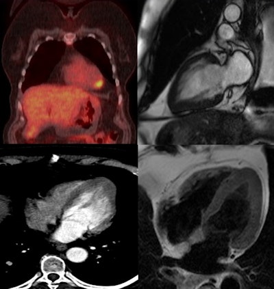 Whole-body PET/CT (top left) shows lung cancer and FDG avidity at the left ventricular apex. Image courtesy of Dr. Esin Gezmis.