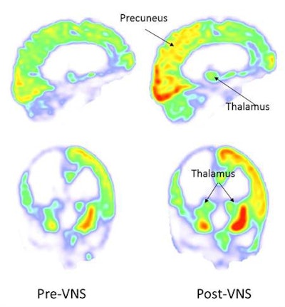 FDG-PET images taken at baseline (left, before vagus nerve stimulation [VNS]) and three months after stimulation (right) show increased activity in the right parieto-occipital cortex, thalamus, and striatum (right, red). Images courtesy of Current Biology.