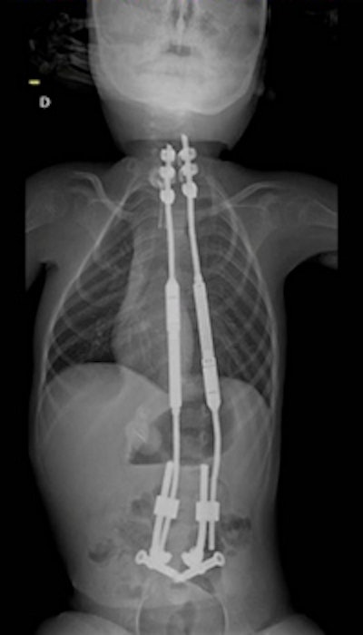 X-ray displaying spinal stem implants.
