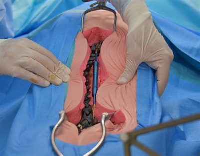 The 3D-printed model of the spine. All image courtesy of Amiens-Picardie University Hospital.