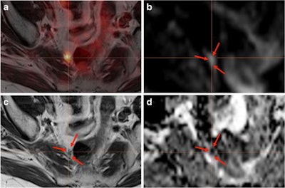 PET/MR images from a 77-year-old patient after therapy. PSMA-PET confirms positive uptake in a pararectal lymph node (a), which is difficult to detect on T2-weighted turbo spin-echo MRI sequences (c), diffusion-weighted MR images (b), and with low apparent diffusion coefficient (d). Figure courtesy of EJNMMI.
