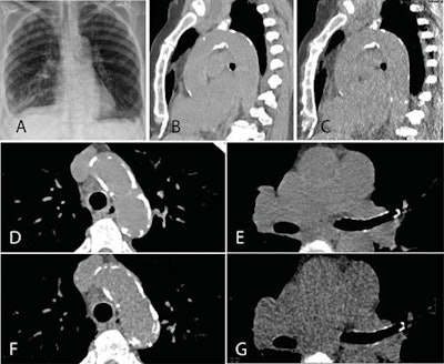 A: Representative posteroanterior chest x-ray image. B, D, and E: Transverse CT sections scanned with standard-dose CT (effective dose 1.57 mSv). C, F, and G: Ultralow-dose CT (effective dose 0.12 mSv) in an 83-year-old woman with a body mass index of 26.1 kg m2. As the images illustrate, ultralow-dose CT allows for anatomically differentiated assessment, with a high agreement of calcium quantity estimation of the aortic valve, ascending aorta, and aortic arch as compared with standard-dose CT. Image courtesy of BJR and Dr. Michael Messerli et al.