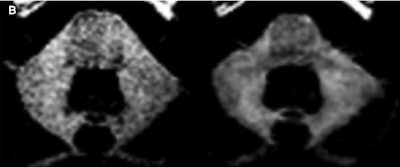 Unenhanced T1-weighted MR image from a patient who received 37 administrations of a macrocyclic GBCA. Patient has visible dentate nucleus enhancement at last MRI scan (1,359 days after first GBCA-enhanced scan) and no dentate nucleus enhancement at baseline. Image courtesy of Radiology.
