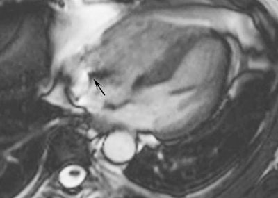 Cardiac MR of a 57-year-old man with a pacemaker. The oblique four-chamber cine steady state with free precession image is not hampered by artifacts from the impulse generator of the pacemaker. Only a small artifact generated by the electro-catheter is visible in the right atrium (black arrow). Image courtesy of Moreno Zanardo.