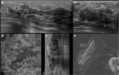 Measurements of ductal carcinoma in situ (DCIS) of the right breast in a 51-year-old woman. ABVS (a, axial plane; b, coronal reconstruction; c, sagittal reconstruction) showed an inhomogeneously hypoechoic mass with irregular margins and with the largest diameter of 67 mm. On ultrasound, (d) the same lesion had a maximum diameter of 39 mm, while on MRI (e) one of 80 mm. Histopathological size was 85 mm. All images courtesy of European Radiology.