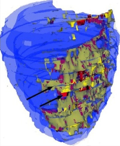 A 3D map of left ventricle. The epicardial and endocardial surfaces of healthy myocardium are marked blue. The zone of infarction has a heterogenic structure. The scar tissue is marked red, and is surrounded by gray zone, which is marked yellow. All images courtesy of Dr. Sergey Ternovoy, PhD.