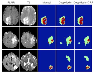 Comparison of delineations of pathological structures (brain tumors) that are used to measure or quantify lesions for further analysis. The column 'manual' shows what a human expert does manually by drawing on the images, which can take hours in 3D. The columns 'DeepMedic' and 'DeepMedic + CRF' show the output of the deep learning approach before and after (+CRF) a refinement step. The delineations are very similar despite the hours taken by human experts to make them compared with the two-minute process accomplished by deep learning. All images courtesy of Ben Glocker, PhD.